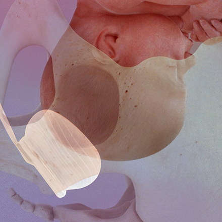Balloon Cephalic Elevation Device